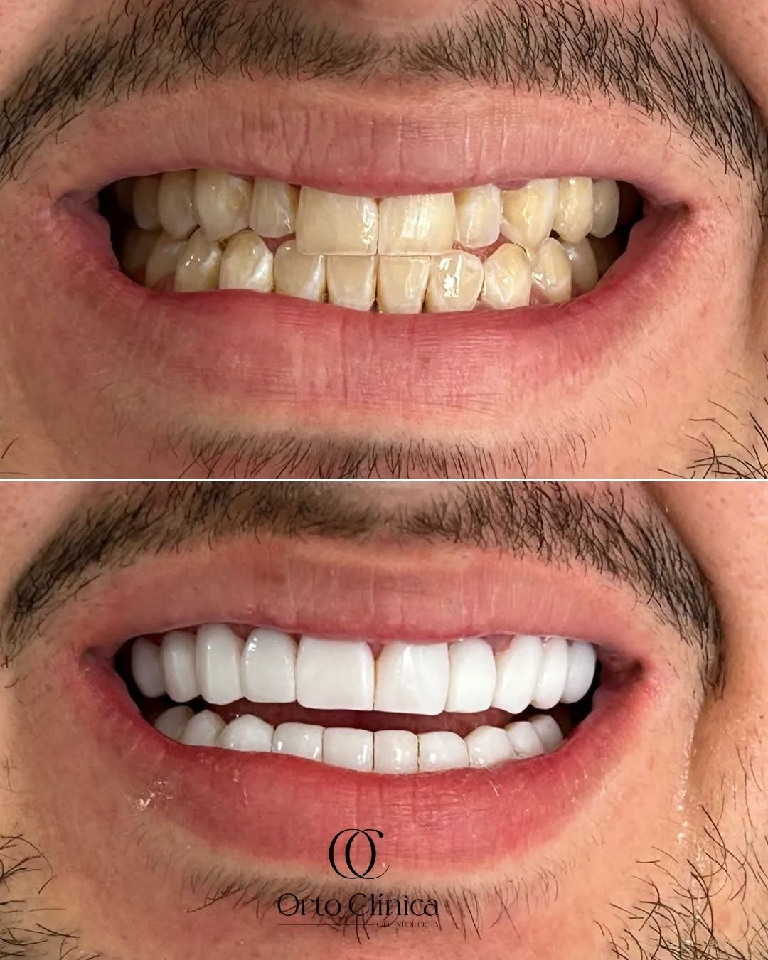 Antes e depois de tratamento odontológico — resultado 1