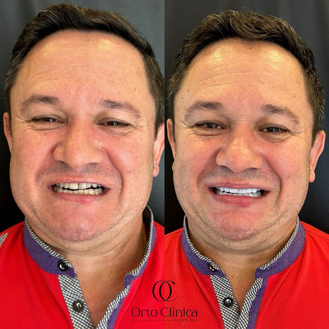 Antes e depois de tratamento odontológico — resultado 2