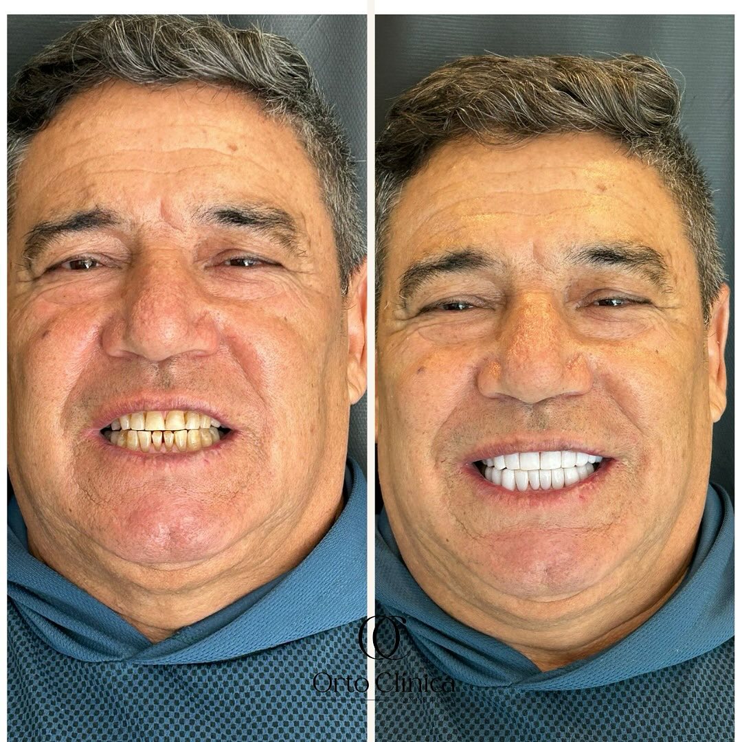 Antes e depois de tratamento odontológico — resultado 3