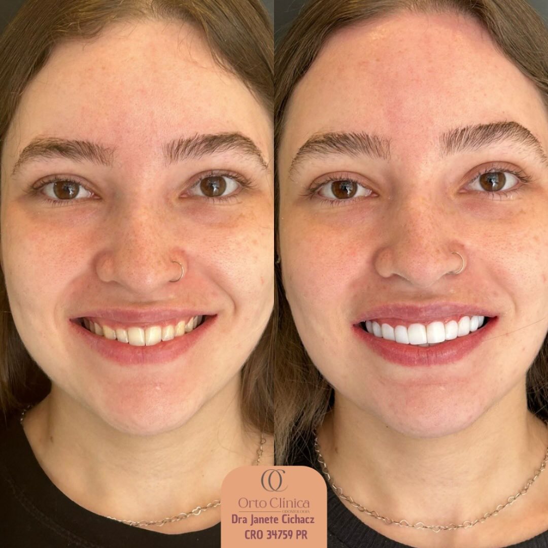 Antes e depois de tratamento odontológico — resultado 4
