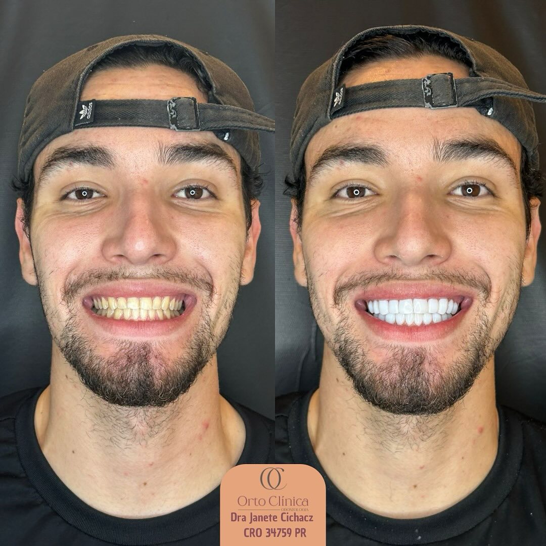Antes e depois de tratamento odontológico — resultado 5