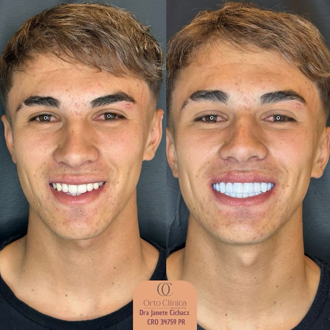 Antes e depois de tratamento odontológico — resultado 6