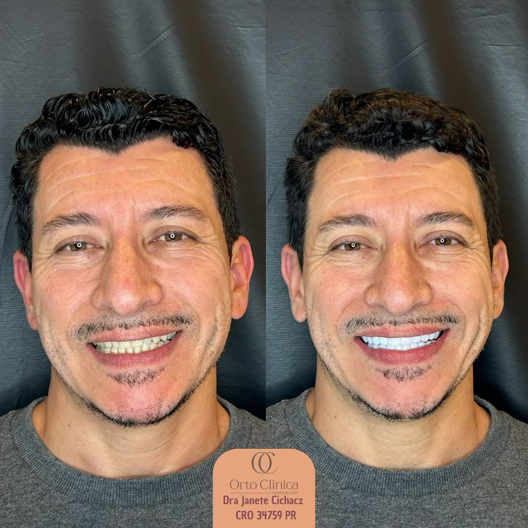 Antes e depois de tratamento odontológico — resultado 7