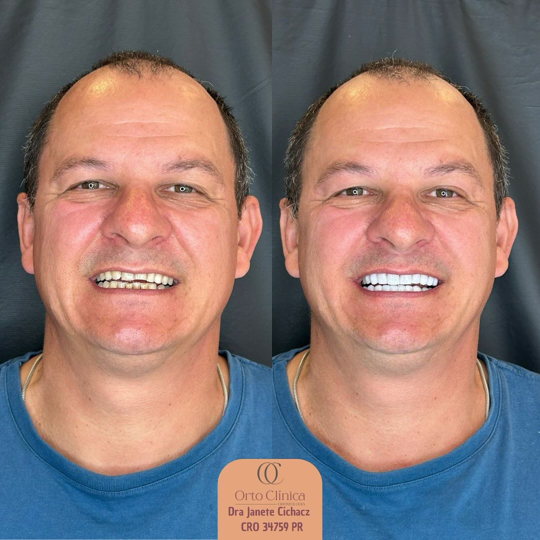 Antes e depois de tratamento odontológico — resultado 8