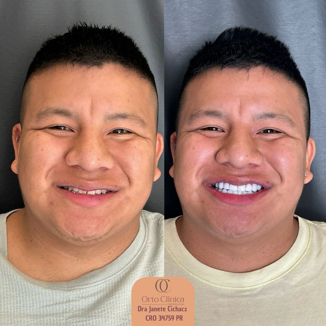 Antes e depois de tratamento odontológico — resultado 9