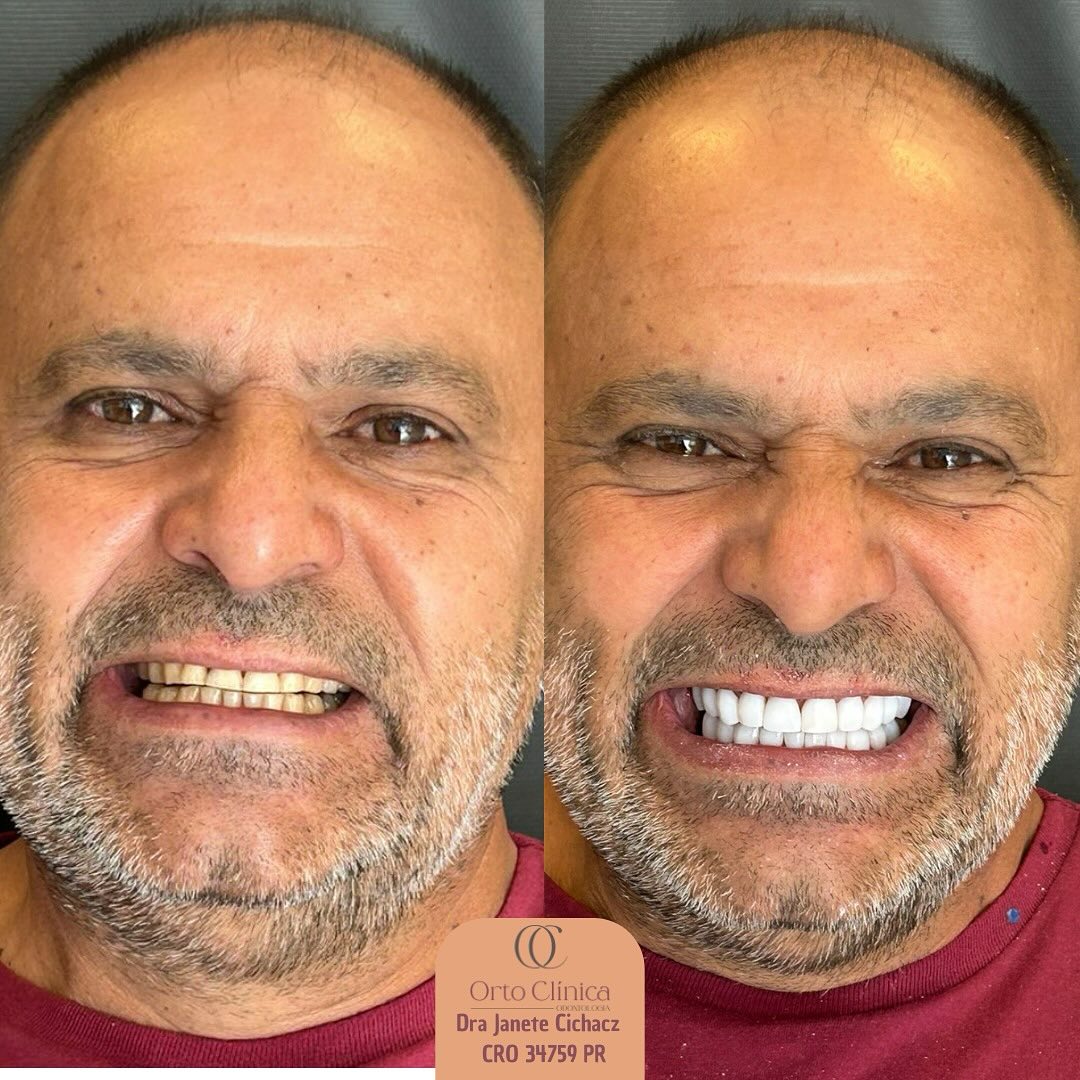 Antes e depois de tratamento odontológico — resultado 10