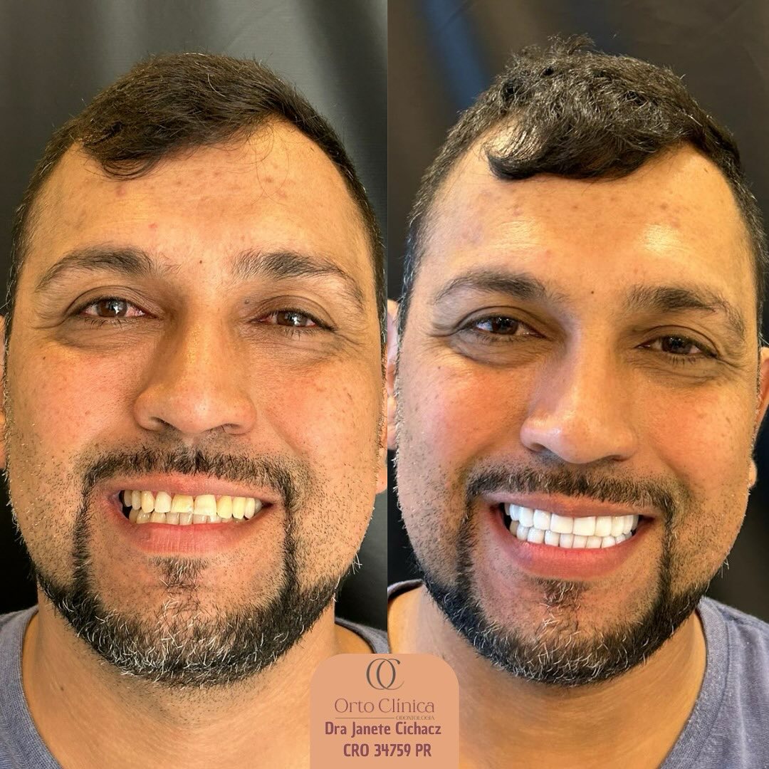 Antes e depois de tratamento odontológico — resultado 11