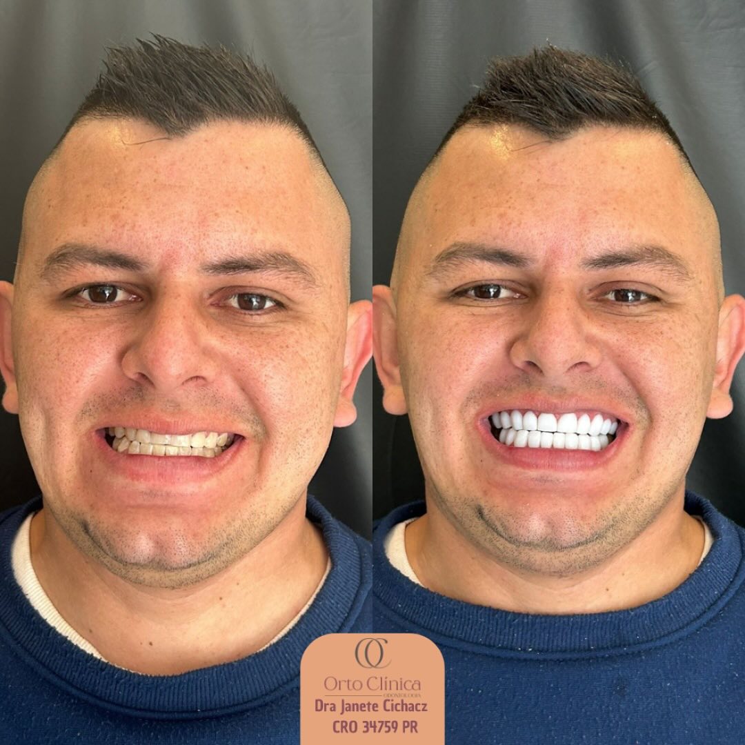 Antes e depois de tratamento odontológico — resultado 12