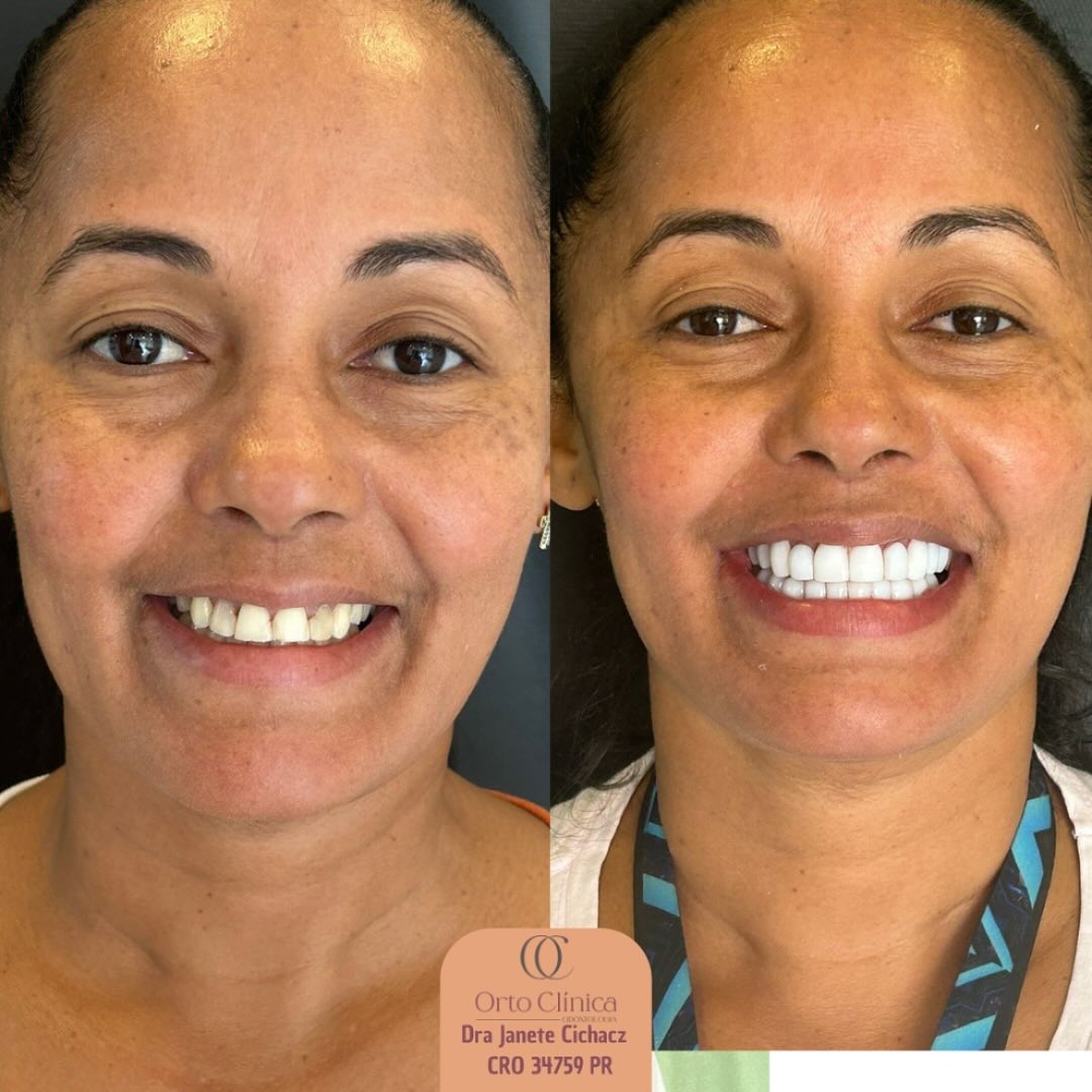 Antes e depois de tratamento odontológico — resultado 13