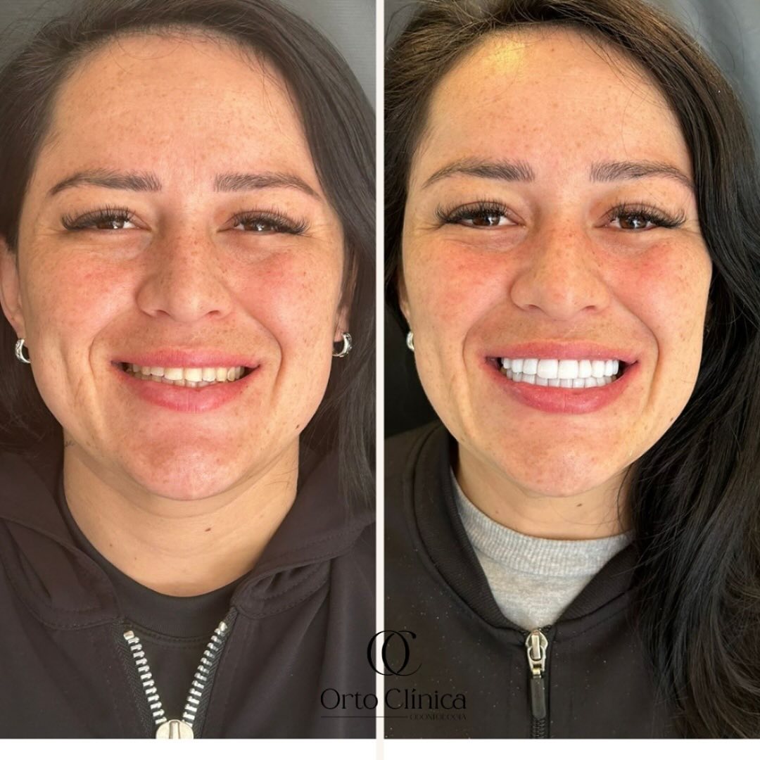 Antes e depois de tratamento odontológico — resultado 14