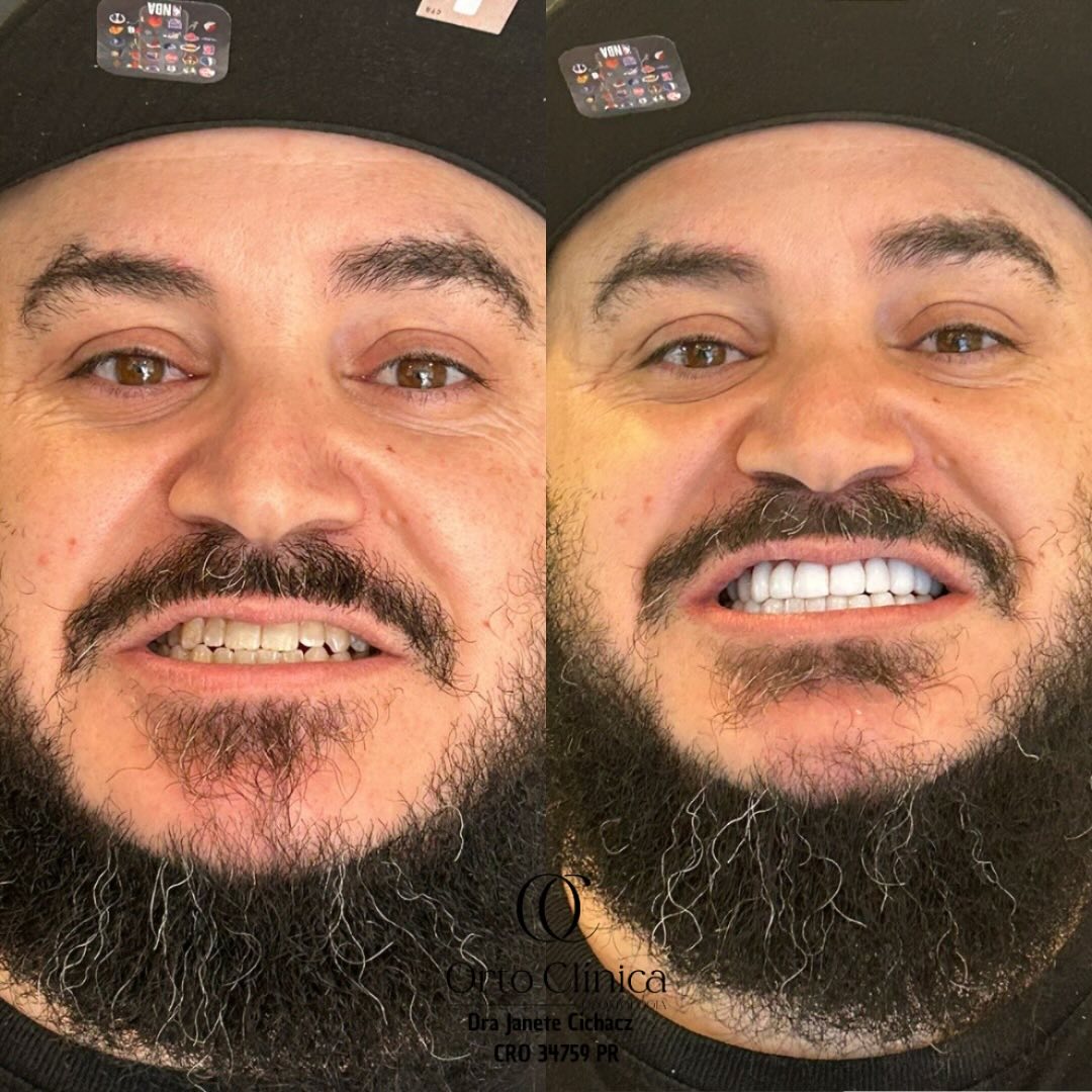 Antes e depois de tratamento odontológico — resultado 15